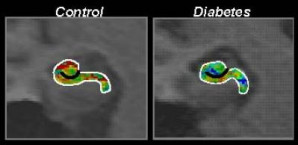 Die Aktivität im Gyrus dentatus ist bei Diabetespatienten im Vergleich deutlich vermindert, was im Bild durch eine kältere Farbgebung gekennzeichnet 