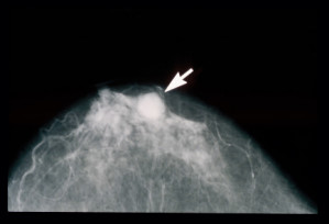 Mammogramm mit Brustkrebstumor (weißer Pfeil)