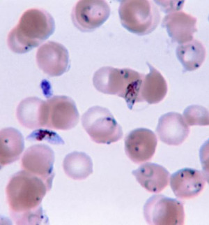 Verschiedene Zellformen von Plasmodium falciparum im gefärbten Blutausstrich