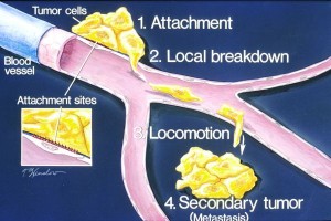 Schematische Darstellung der Entwicklung von Metastasen 