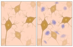 Bei der Alzheimer-Demenz bilden sich unter anderem Ablagerungen von Beta-Amyloid (blau) zwischen den Nervenzellen.