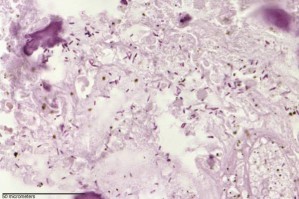 In einem Hundetumor haben sich aus Sporen hervorgegangene stäbchenförmige Clostridium novyi-Bakterien vermehrt.