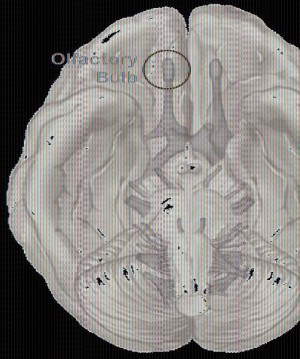 Der Riechkolben (eingekreiste Struktur im Hirnscan) leitet Geruchsinformationen von der Nase zum Gehirn.