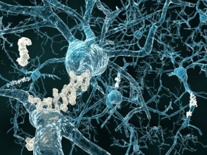Bei der Alzheimer-Demenz bilden sich Ablagerungen aus Beta-Amyloid (weiß) zwischen den Hirnzellen.