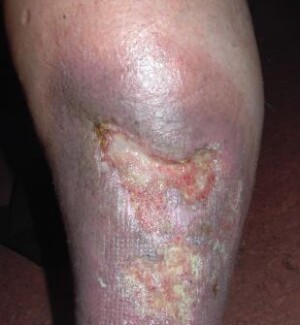 Chronische Wunden wie das offene Bein (Ulcus cruris) sind häufig mit Pseudomonaden infiziert, die Bakteriophagen freisetzen.