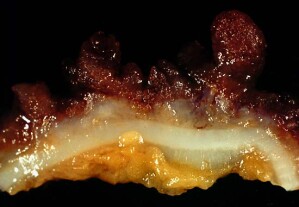Längsschnitt durch die Dickdarmwand bei Colitis ulcerosa (entzündete Schleimhaut rot gefärbt)