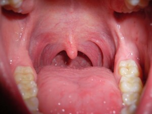 Lungenkrebs: Veränderte Artenvielfalt von Bakterien im Mund thumbnail