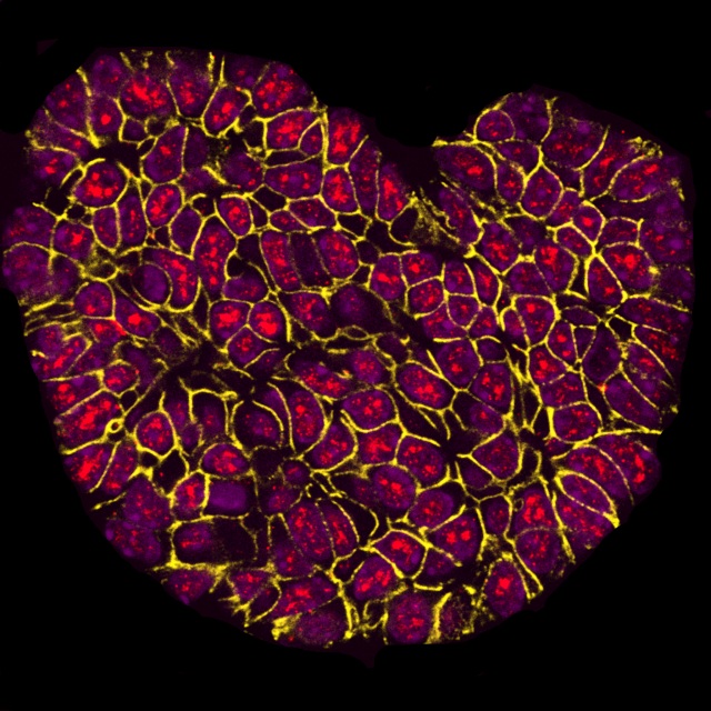 Gesamtsieger des Wettbewerbs „BMC ‚Research in Progress‘ photo competition“ ist das Foto von Sarah Boyle (Centre for Cancer Biology, Adelaide) mit dem Titel „I Heart Research“. Die fluoreszenzmikroskopische Aufnahme zeigt Gewebe des Brusttumors einer Maus. Ein für die Krebsentwicklung wichtiges Protein ist rot markiert. Die Siegerfotos werden in einem Blog (http://blogs.biomedcentral.com/bmcblog/2017/09/29/bmc-research-in-progress-photo-competition-the-winning-images/) vorgestellt.