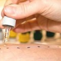 Bei einem Prick-Test prüft der Arzt das Ausmaß einer Allergie über Hautreaktionen