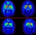 Positronen-Emissions-Tomographie-Aufnahmen des Gehirns (oben: Kontrolle, unten: Parkinson-Patient)