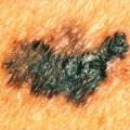 Melanome haben oft unterschiedlich schwarz und braun gefärbte Bereiche und eine unregelmäßige Begrenzung.