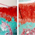 Eine Behandlung mit Antikörpern gegen den Wachstumsfaktor TGF-beta1 (rechtes Bild) verhindert Arthroseschäden im Kniegelenk von Ratten (linkes Bild: ohne Behandlung, Knochen = grün, Knorpel = rot).
