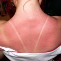 Häufiger Sonnenbrand erhöht das Hautkrebsrisiko.