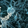 Bei der Alzheimer-Krankheit bilden sich Beta-Amyloid-Ablagerungen (weiß) im Gehirn.