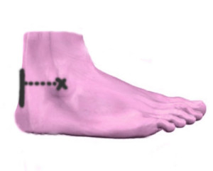 Gemessen wurde der durchschnittliche horizontale Abstand zwischen Knöchel und Achillessehne an der Innen- bzw. Außenseite des Beines