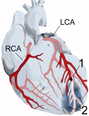 Herzinfarkt der Vorderwandspitze (2) nach Verschluss (1) der linken Kranzarterie (LCA)