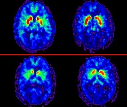 Positronen-Emissions-Tomographie-Aufnahmen des Gehirns (oben: Kontrolle, unten: Parkinson-Patient)