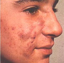 Die typischen Hautveränderungen bei Akne können belastende Ausmaße annehmen