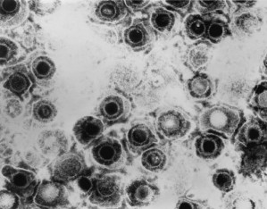 Herpes-simplex-Viren