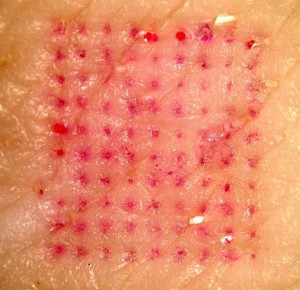 Abdruck des Nadelpflasters auf der Haut eines Schweins, wobei die Nadeln einen roten Farbstoff enthielten.