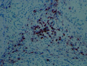 Aus iPS-Zellen entstandenes Gewebe wird von Immunzellen (dunkelbraun gefärbt) angegriffen.