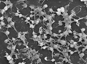 Staphylococcus aureus-Biofilm auf einem Katheter