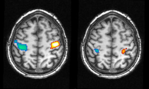 Aktivität in der motorischen Hirnrinde bei einer tatsächlich ausgeführten Bewegung der Hände im Wachen (links) und während einer geträumten Bewegung (rechts) - blaue Regionen spiegeln die Bewegung der rechten Hand wider, die in der linken Gehirnhälfte deutlich wird, rote die entsprechende Bewegung der linken Hand in der gegenüberliegenden Hirnhälfte 