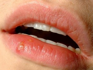 Durch Herpes-simplex-Viren vom Typ 1 ausgelöster Lippenherpes (Herpes labialis)