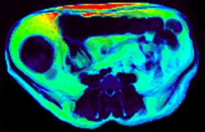 Kernspintomographie-Aufnahme eines fettleibigen Rhesusaffen vor der Behandlung (Bauchfett = rot)