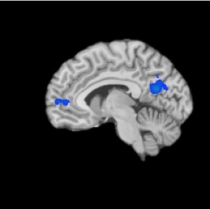 Forscher verwendeten Magnetresonanztomographie, um die Aktivitäten im Gehirn von Meditierenden sichtbar zu machen. Die Bereiche, die im Bild blau hervorgehoben sind, zeigen verringerte Aktivität.