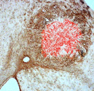 In das Gehirn einer Maus injizierte Tumorzellen (rot) sind nach 14 Tagen von zahlreichen Stamm- und Vorläuferzellen (braun) umgeben.
