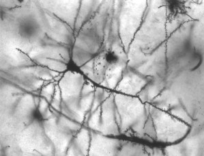 Neuronen des zentralen Nervensystems werden bei Multipler Sklerose durch Immunreaktionen geschädigt.