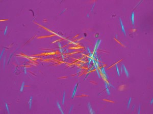 Harnsäurekristalle aus der Gelenksflüssigkeit eines Patienten, fotografiert im polarisierten Licht
