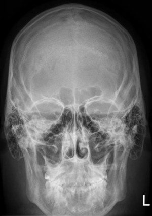 Das Röntgenbild des menschlichen Schädels zeigt die Nasennebenhöhlen.