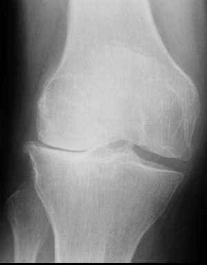 Röntgenaufnahme einer Kniegelenksarthrose
