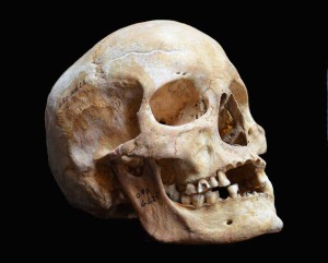 Schädel von Jorgen 625, einem im Mittelalter verstorbenen Leprakranken aus Odense in Dänemark