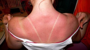 Häufiger Sonnenbrand erhöht das Hautkrebsrisiko.