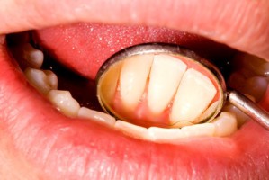 Regelmäßige Zahnpflege verhindert auch ein übermäßiges Wachstum von Fusobakterien im Mund.
