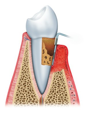 Bei einer Parodontitis bilden sich tiefe Zahnfleischtaschen, in denen sich die Krankheitserreger vermehren.