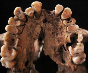 Ein 14.000 bis 15.000 Jahre alter Oberkiefer aus der “Grotte des Pigeons” bei Taforalt in Marokko zeigt einen ungewöhnlich starken Kariesbefall der Zähne.