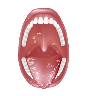 Weiße Beläge auf Zunge und Mundschleimhaut sind Merkmale von Soor, einer Form der Kandidose.