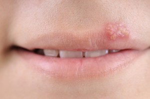 Eine akute Infektion mit Herpes simplex-Viren äußert sich meist in Form von Lippenbläschen.