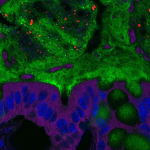 Darmbakterien (rot) haben die Schleimschicht (grün) bereits weitgehend durchdrungen und sind der Darmschleimhaut (blau/violett) sehr nahe gekommen.