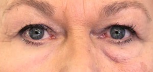 Nach mehrfachem Auftragen der künstlichen Haut unterhalb des einen Auges (linke Bildseite) haben sich die Tränensäcke zurückgebildet (zum Vergleich auf der rechten Bildseite die entsprechende unbehandelte Region).