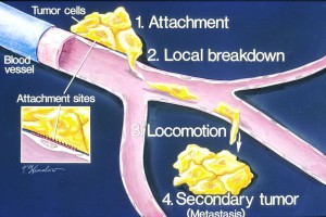 Wenn Krebszellen in ein Blutgefäß eindringen (1,2), können sie zu einer anderen Stelle des Körpers transportiert werden (3) und dort neue Tumoren (4) bilden.
