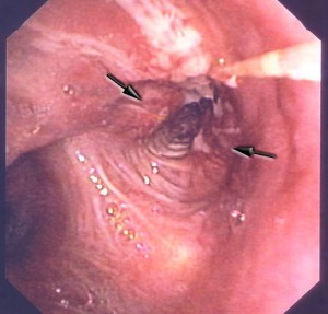 Bronchoskopisches Bild eines Bronchialkarzinoms (Pfeile), das den linken Oberlappenbronchus bereits leicht einengt