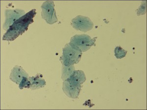 Gardnerella vaginalis mit Epithelzellen eines Vaginalabstrichs (gefärbt)