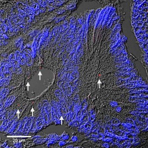 Direkter Nachweis von Streptococcus gallolyticus in menschlichem Krebsgewebe durch Immunfluoreszenz-Mikroskopie: Die Pfeile zeigen die rot gefärbten Streptokokken an.