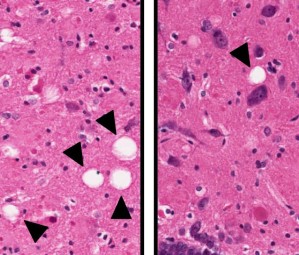 Im Vergleich zu unbehandelten Ratten (links) zeigt das Hirngewebe der behandelten Tiere (rechts) weniger „Löcher“ (Pfeile), die abgestorbene Neuronen hinterlassen haben.