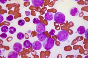 Blutbild bei chronisch myeloischer Leukämie (CML) mit erhöhter Zahl weißer Blutkörperchen